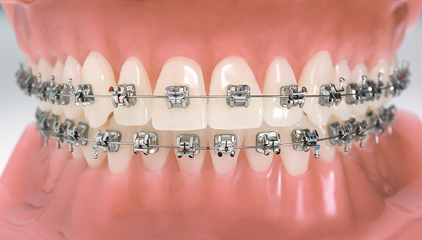 braces without brackets